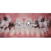 BRACKETS AUTOLIGABLES