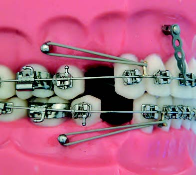 IMPLANTES ORTODONTICOS